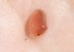 Cyzicidae