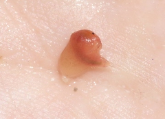 Cyzicidae
