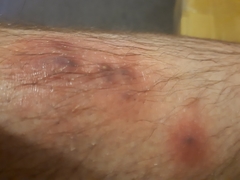 Staphylococcus aureus