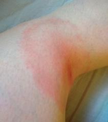 Borrelia