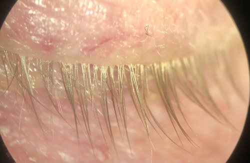Human Follicle Mite