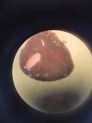 Bilobella braunerae