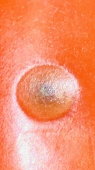 Colletotrichum coccodes