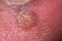 Firstpapillomavirinae