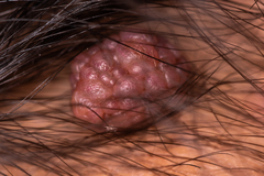 Firstpapillomavirinae