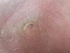 Firstpapillomavirinae