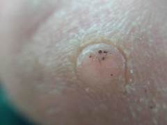 Firstpapillomavirinae