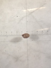 Vertigo angustior