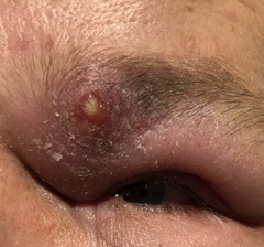 Staphylococcus aureus