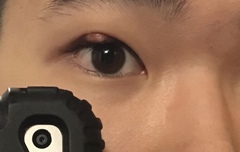 Staphylococcus aureus