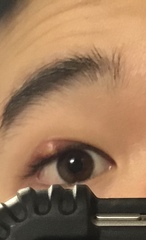 Staphylococcus aureus