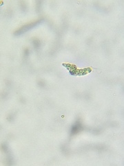 Astasia