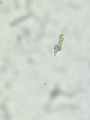 Astasia