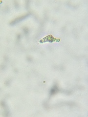Astasia