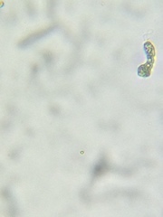 Astasia