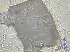 Phialemonium inflatum