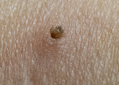 Ixodidae