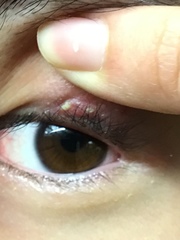 Staphylococcus aureus