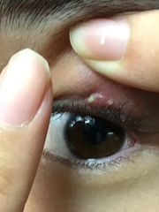 Staphylococcus aureus