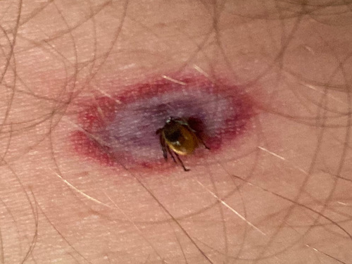 Eastern Black-legged Tick, Goodhue County, MN, USA, photo 8 of 10