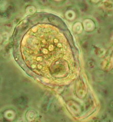 Hyalosphenia