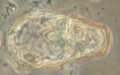 Hyalosphenia