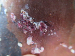 Eriococcus lagerstroemiae