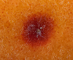 Quadraspidiotus perniciosus