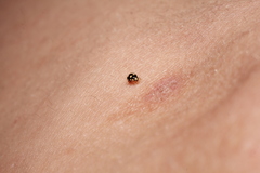 Brachiacantha uteella