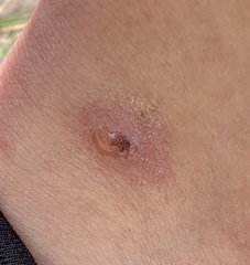 Staphylococcus aureus