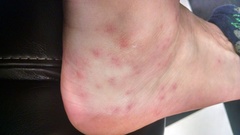 Eutrombicula alfreddugesi