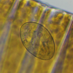 Glaucoma scintillans