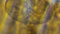 Glaucoma scintillans