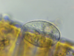 Glaucoma scintillans