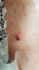 Ixodidae