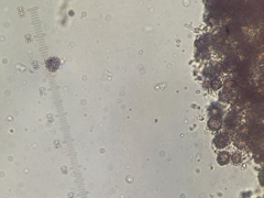 Scleroderma