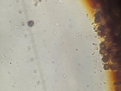 Scleroderma