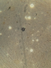 Scleroderma
