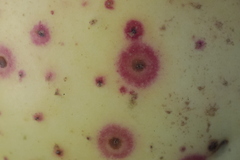 Quadraspidiotus perniciosus