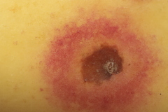 Quadraspidiotus perniciosus