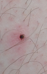 Ixodidae