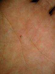 Ixodidae