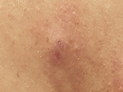 Staphylococcus aureus