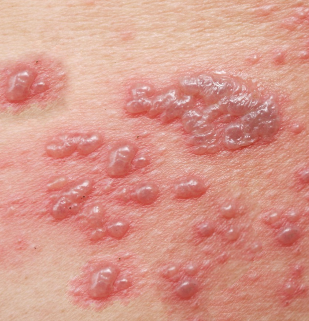 Chicken Wire Rash chicken pox from Kyiv, Solomians'kyi district on January 22, 2023 by ...