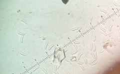 Sclerencoelia
