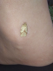 Oligoloba severa