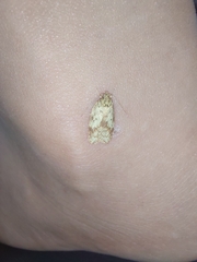 Oligoloba severa
