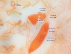 Pezicula ocellata