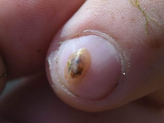 Ancylus fluviatilis