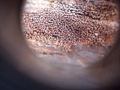 Hyphodontia